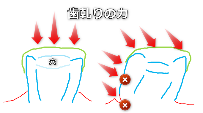 歯軋り　横の力　歯茎　細菌