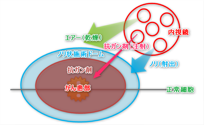 ノリ　抗がん剤　治療法